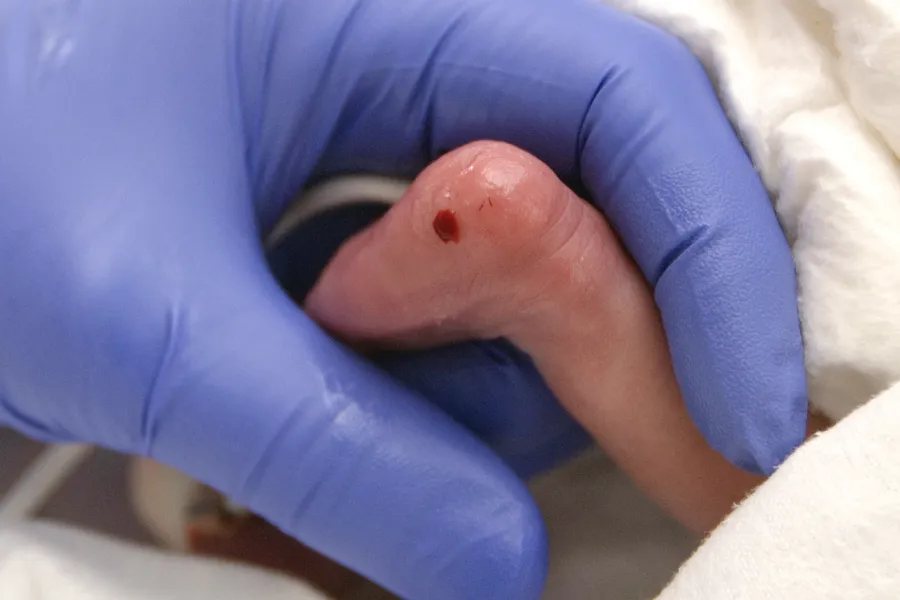 Blodprøve tas fra baby